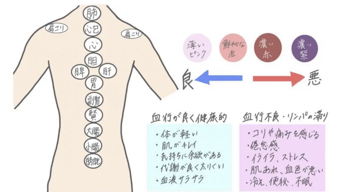 カッピング | らく鍼灸接骨院